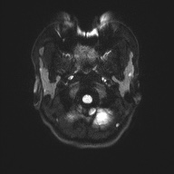 File:Cerebral cavernous venous malformation (Radiopaedia 70008-80021 Axial DWI 32).jpg