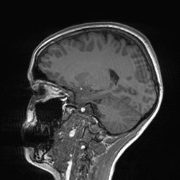 File:Cerebral cavernous venous malformation (Radiopaedia 70008-80021 Sagittal T1 28).jpg