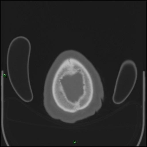 Cerebral contusions (Radiopaedia 33868-35039 Axial bone window 214).jpg