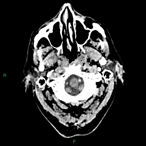 Cerebral contusions (Radiopaedia 33868-35039 Axial non-contrast 13).jpg