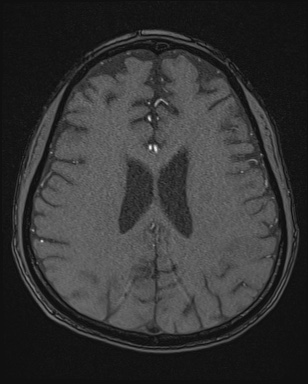 Cerebral embolic infarcts (embolic shower) (Radiopaedia 72391-82921 Axial MRA 132).jpg