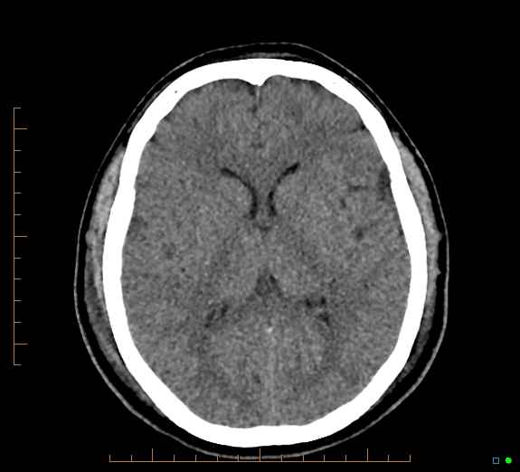 Cerebral fat embolism (Radiopaedia 85521-101224 Axial non-contrast 27).jpg