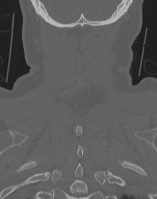 Cerebral hemorrhagic contusions and cervical spine fractures (Radiopaedia 32865-33841 Coronal bone window 69).jpg