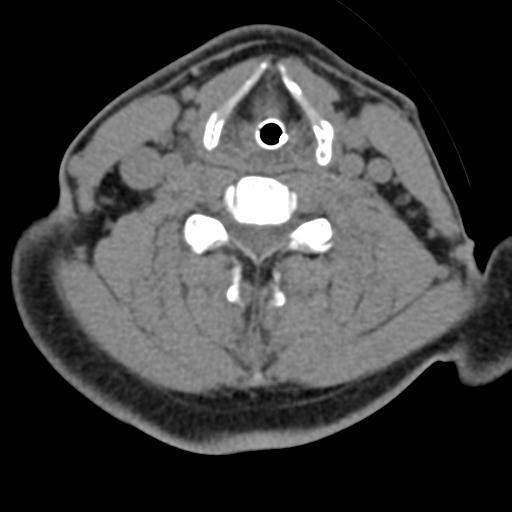 Cerebral hemorrhagic contusions and cervical spine fractures (Radiopaedia 32865-33841 F 34).jpg
