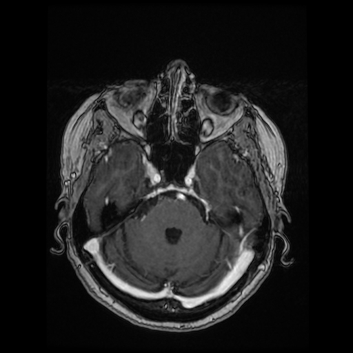 Cerebral metastases - melanoma (Radiopaedia 80972-94522 Axial T1 C+ 39).jpg