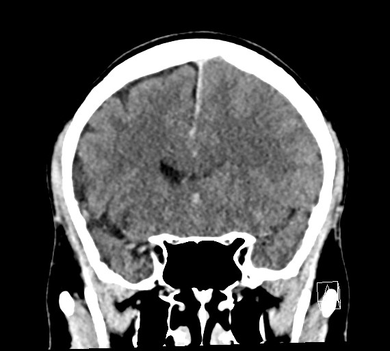 Cerebral metastases - testicular choriocarcinoma (Radiopaedia 84486-99855 D 22).jpg