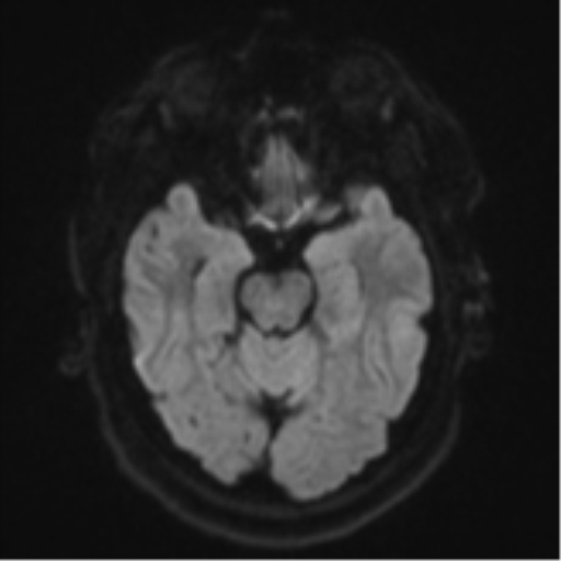 Cerebral metastases mimicking multifocal glioblastoma (Radiopaedia 50843-56353 Axial DWI 38).png