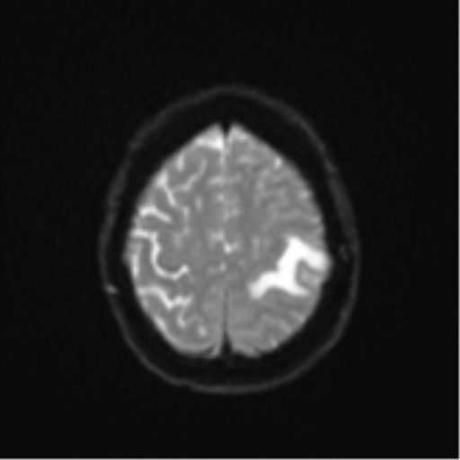 Cerebral metastasis (Radiopaedia 46744-51248 Axial DWI 23).png