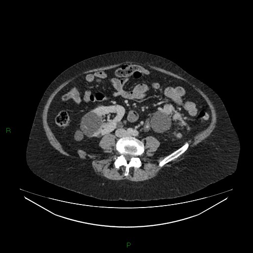 File:Cerebral metastasis from renal cell carcinoma (Radiopaedia 82306-96378 A 109).jpg