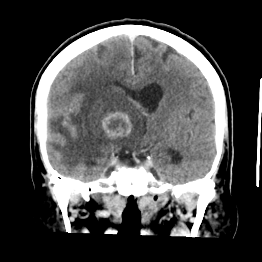 Cerebral metastasis to basal ganglia (Radiopaedia 81568-95412 Coronal C+ delayed 31).png