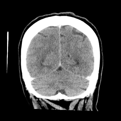 Cerebral metastasis to basal ganglia (Radiopaedia 81568-95412 Coronal C+ delayed 49).png