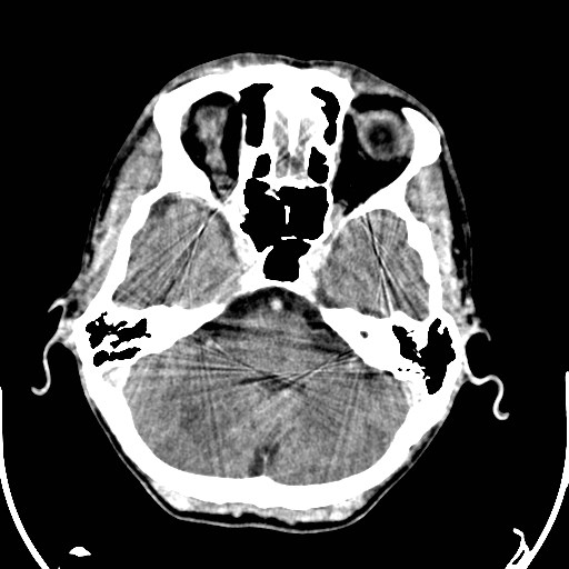 File:Cerebral toxoplasmosis (Radiopaedia 43956-47460 Axial C+ delayed 6).jpg