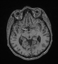 Cerebral toxoplasmosis (Radiopaedia 43956-47461 Axial T1 33).jpg
