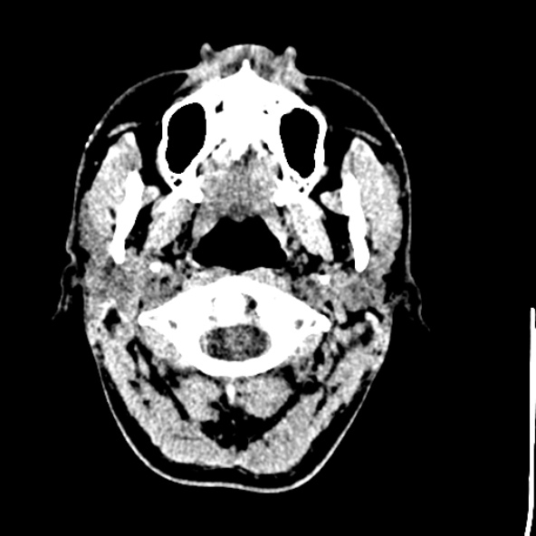 Cerebral toxoplasmosis (Radiopaedia 53993-60131 Axial non-contrast 3).jpg
