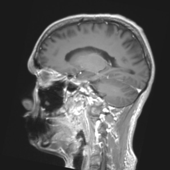 File:Cerebral toxoplasmosis (Radiopaedia 53993-61435 Coronal T1 14).jpg
