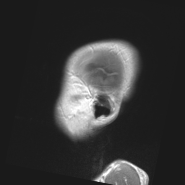 File:Cerebral toxoplasmosis (Radiopaedia 53993-61435 Coronal T1 4).jpg