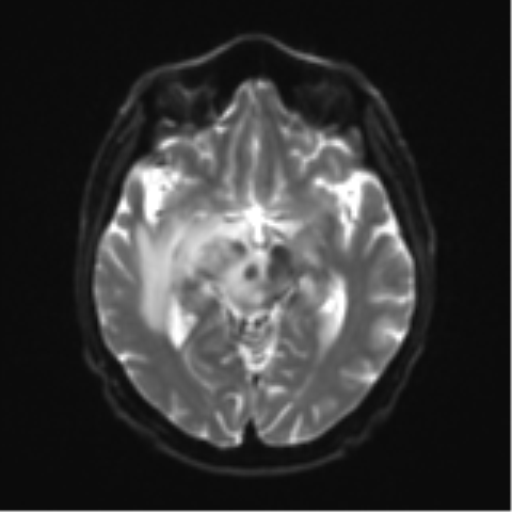 File:Cerebral toxoplasmosis (Radiopaedia 54575-60804 Axial DWI 15).png
