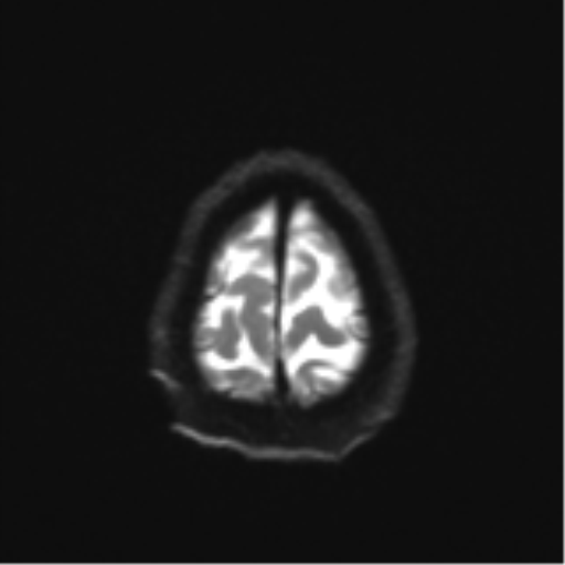 Cerebral toxoplasmosis (Radiopaedia 54575-60804 Axial DWI 29).png