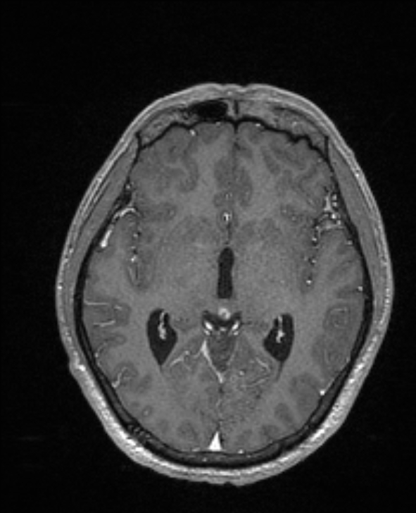 Cerebral toxoplasmosis (Radiopaedia 85779-101597 Axial T1 C+ 79).jpg