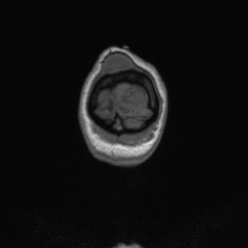 Cerebral tuberculosis with dural sinus invasion (Radiopaedia 60353-68090 Coronal T1 174).jpg