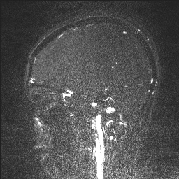 Cerebral tuberculosis with dural sinus invasion (Radiopaedia 60353-68090 Sagittal MRV 46).jpg