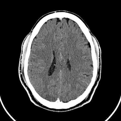 Cerebral venous angioma (Radiopaedia 69959-79977 B 63).jpg