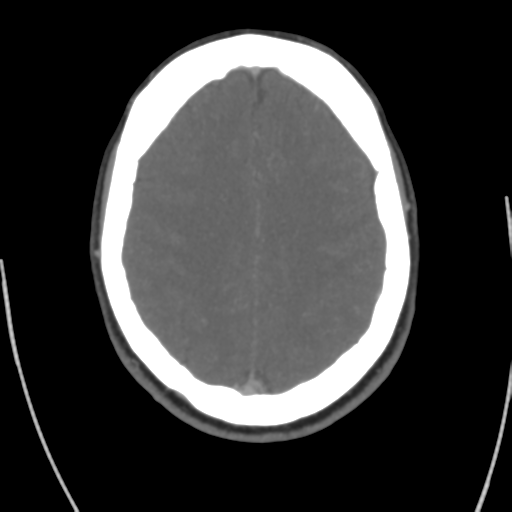 File:Cerebral venous infarct related to dural venous sinus thromboses (Radiopaedia 35292-36804 Axial C+ delayed 35).png