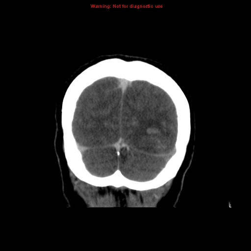 Cerebral venous infarction (Radiopaedia 12404-20735 B 73).jpg