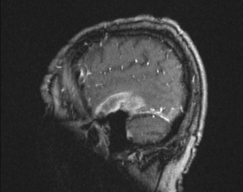 Cerebral venous infarction (Radiopaedia 65166-74176 Sagittal TOF 14).jpg