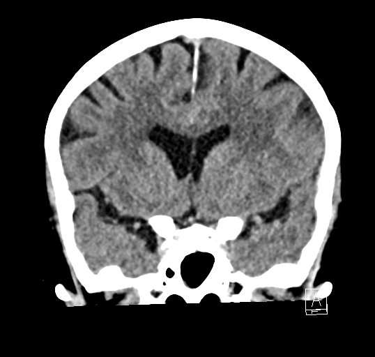 Cerebral venous infarction with hemorrhage (Radiopaedia 65343-74381 Coronal non-contrast 19).jpg