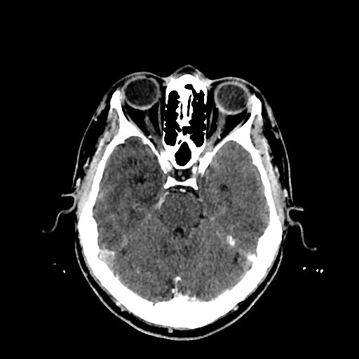 File:Cerebral venous thrombosis (CVT) (Radiopaedia 77524-89685 Axial with contrast 13).jpg