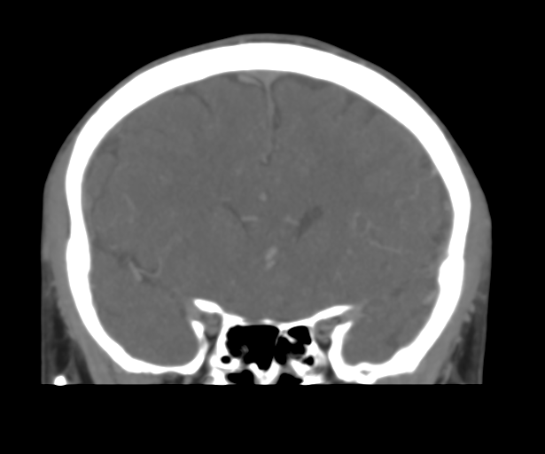 Cerebral venous thrombosis (Radiopaedia 38392-40467 Coronal CTA-Venogram 22).png