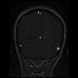 Cerebral venous thrombosis - ulcerative colitis (Radiopaedia 66049-75219 Coronal MRV 32).jpg