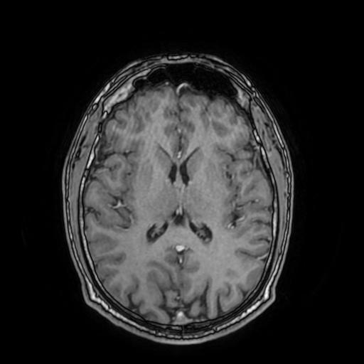 File:Cerebral venous thrombosis with secondary intracranial hypertension (Radiopaedia 89842-106957 Axial T1 C+ 103).jpg