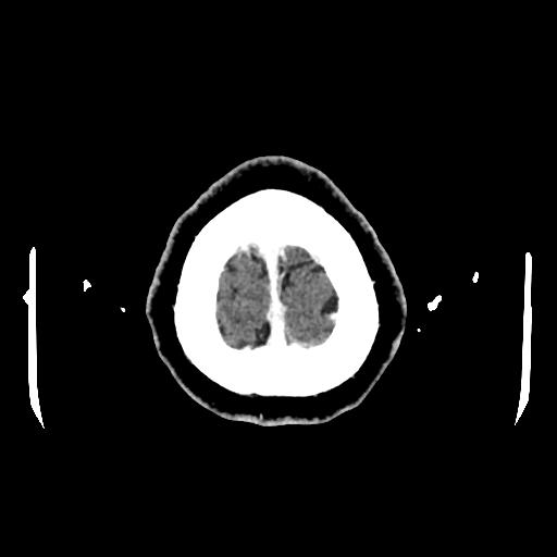 Cerebral venous thrombosis with venous hemorrhagic infarct (Radiopaedia 90354-107660 Axial with contrast 160).jpg
