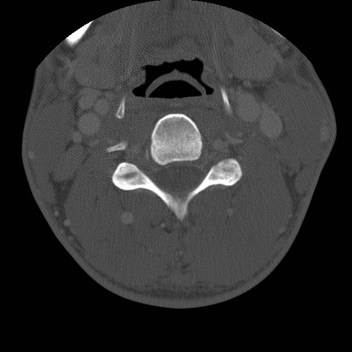 Cervical Pott disease (Radiopaedia 20374-20286 Axial bone window 73).jpg