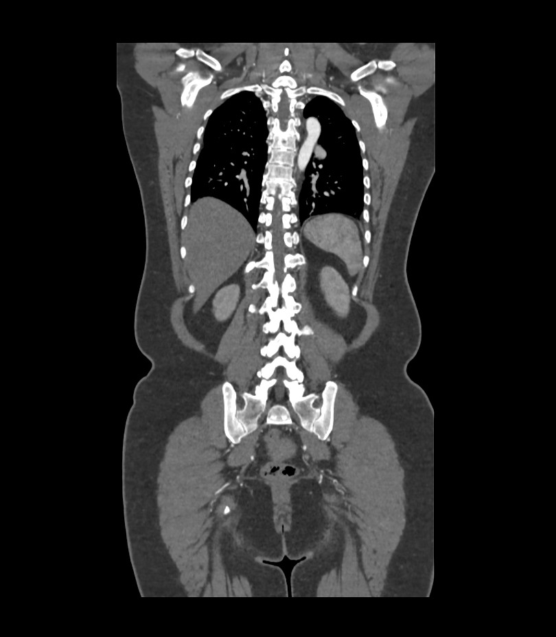 Cervical aortic arch with coarctation and aneurysms (Radiopaedia 44035-47552 C 11).jpg
