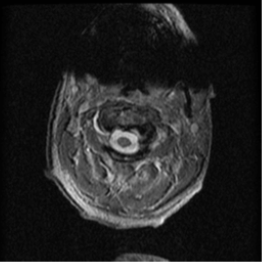 Cervical canal stenosis with cord compression (Radiopaedia 34114-35374 Axial Gradient Echo 84).png