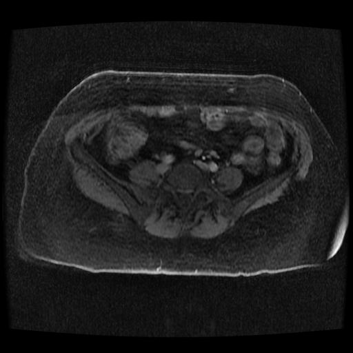 Cervical carcinoma (Radiopaedia 70924-81132 Axial T1 C+ fat sat 83).jpg