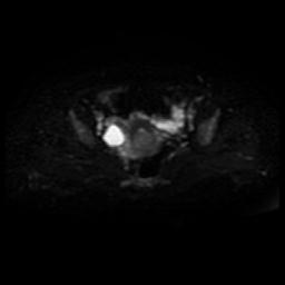 Cervical carcinoma (Radiopaedia 88010-104555 Axial DWI 12).jpg