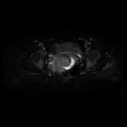 File:Cervical carcinoma (Radiopaedia 88010-104555 Axial DWI 9).jpg