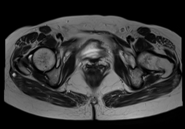 File:Cervical carcinoma (Radiopaedia 88312-104943 Sagittal T1 17).jpg