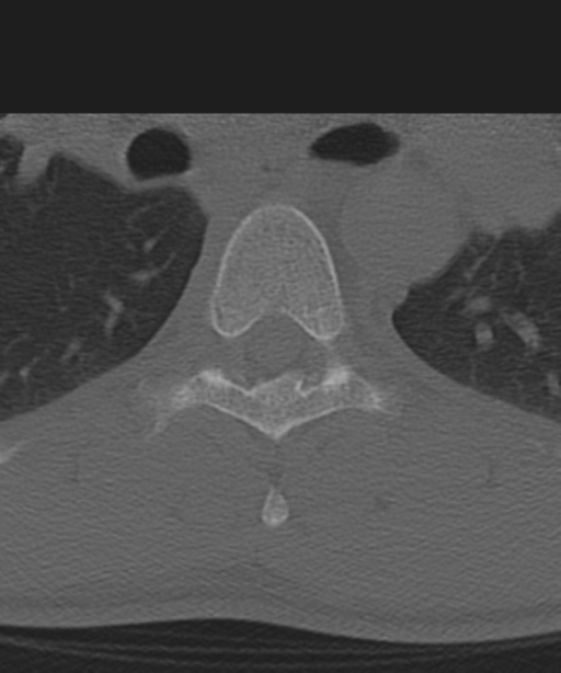 Cervical intercalary bone (Radiopaedia 35211-36748 Axial bone window 90).png