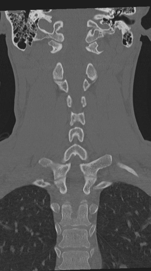 Cervical intercalary bone (Radiopaedia 35211-36748 Coronal bone window 47).png