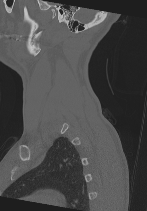 Cervical intercalary bone (Radiopaedia 35211-36748 Sagittal bone window 10).png