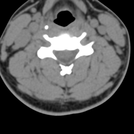 Cervical schwannoma (Radiopaedia 57979-64974 Axial non-contrast 35).png