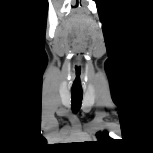 File:Cervical schwannoma (Radiopaedia 57979-64974 Coronal non-contrast 7).png