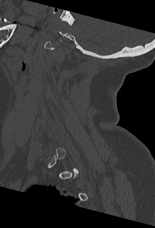 Cervical spine ACDF loosening (Radiopaedia 48998-54070 Sagittal bone window 24).png