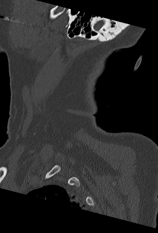 Cervical spine ACDF loosening (Radiopaedia 48998-54070 Sagittal bone window 77).png