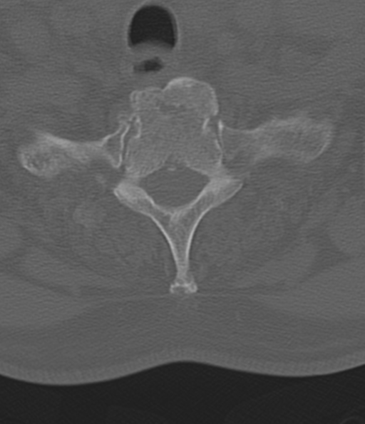File:Cervical spine fracture in the setting of ankylosis (Radiopaedia 37038-38715 Axial bone window 52).png